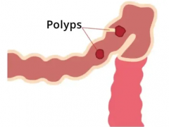 应用 PDOS 对罕见病 FAP 和 MAP 患者进行肿瘤防治